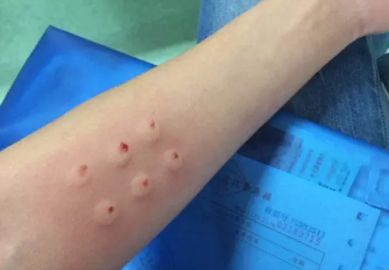 兩次胎停育第三次成功生男孩 胎停育做封閉抗體治療經驗