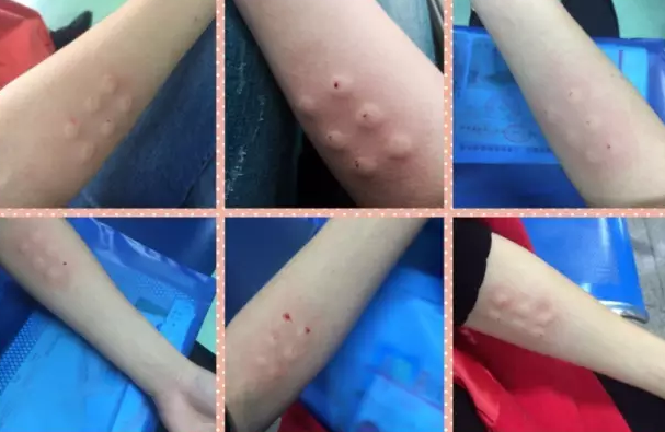 兩次胎停育第三次成功生男孩 胎停育做封閉抗體治療經驗