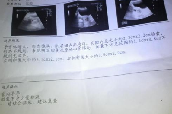 胎停育后成功懷孕經驗 胎停一個月后立刻懷孕寶寶健康出生