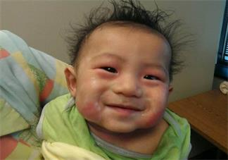 孩子濕疹會導(dǎo)致哮喘嗎 孩子濕疹怎么預(yù)防比較好2018