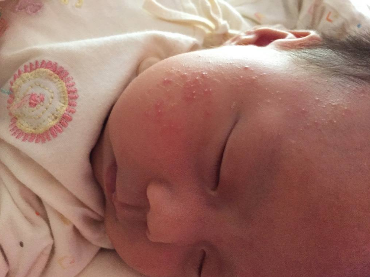 孩子濕疹會導(dǎo)致哮喘嗎 孩子濕疹怎么預(yù)防比較好2018