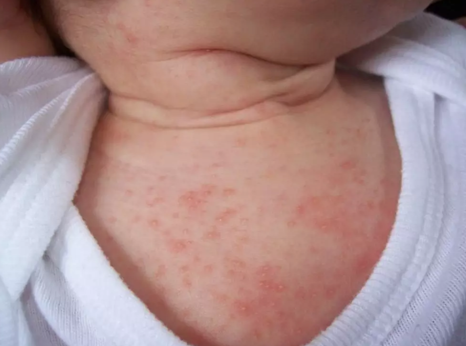 怎么分辨嬰兒的皮膚問題 如何快速區分寶寶皮膚病 