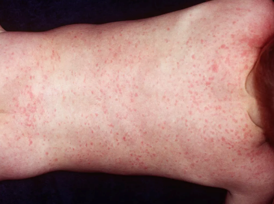 怎么分辨嬰兒的皮膚問題 如何快速區分寶寶皮膚病 