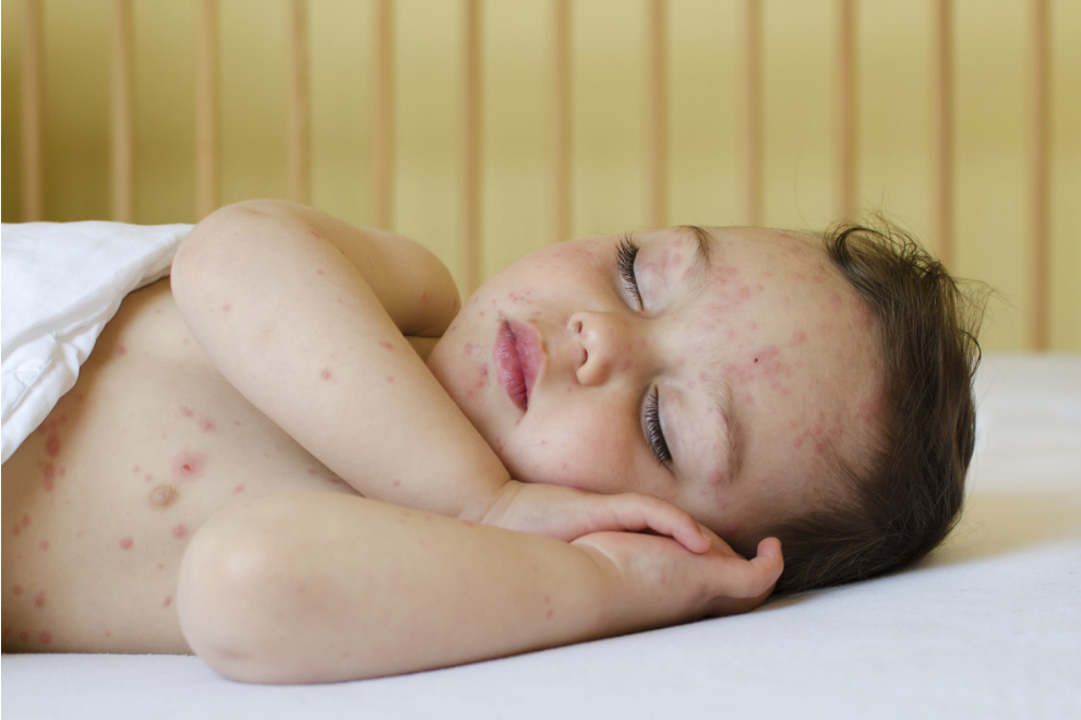 寶寶被蟲咬了起水泡怎么辦 2018夏季寶寶蟲咬皮炎如何處理