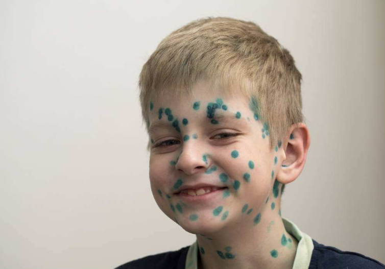 小孩子出水痘怎么護理 怎么及時預防水痘2018