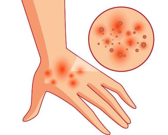 小孩子出水痘怎么護理 怎么及時預防水痘2018