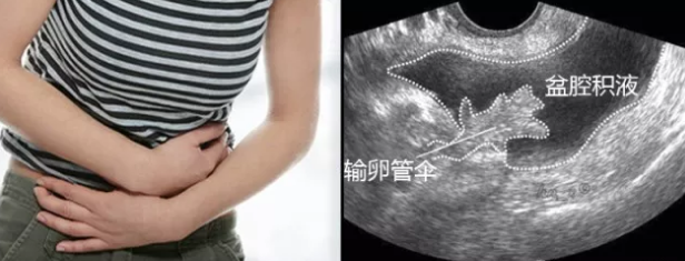 盆腔積液流血怎么回事 盆腔積液流血怎么辦