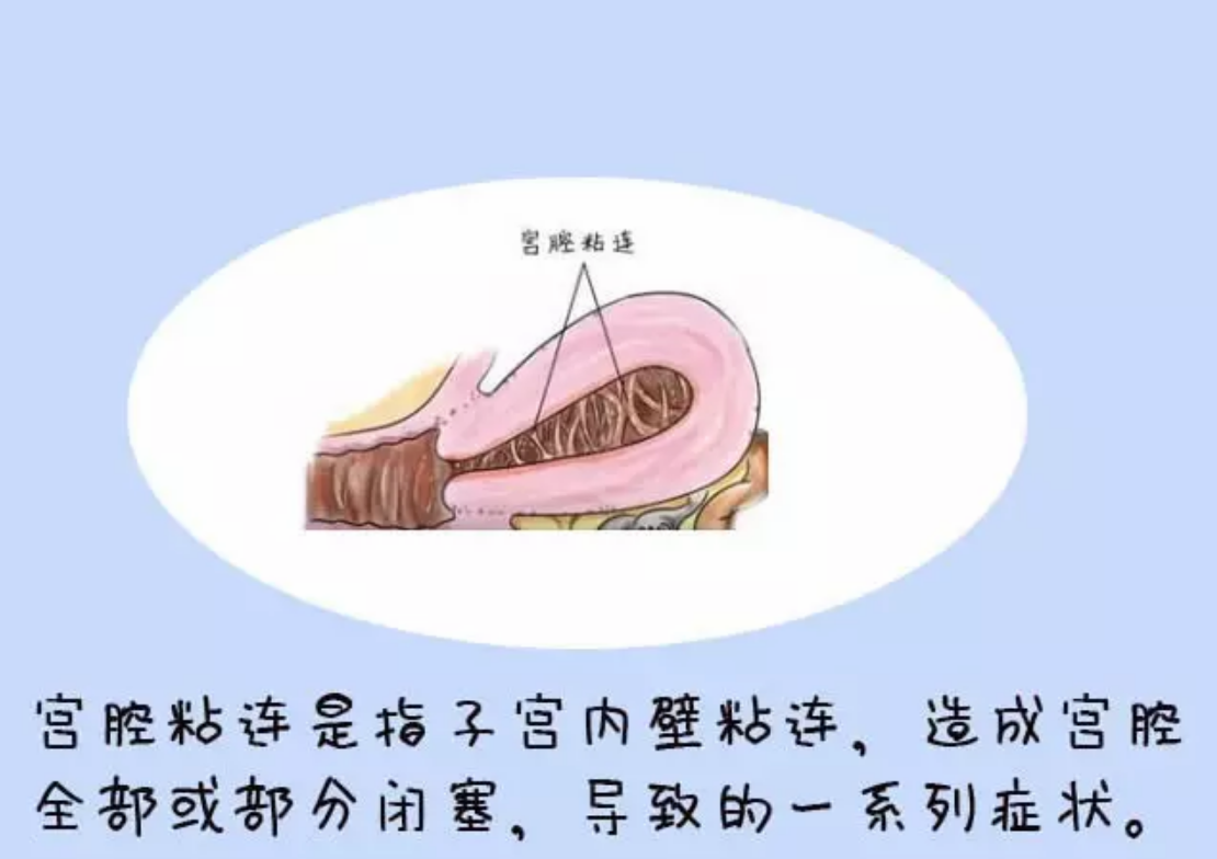 宮頸粘連可以做試管嬰兒嗎 宮頸粘連會不會影響試管成功率