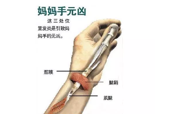 熊黛林媽媽手是什么 媽媽手怎么治療2018 熊黛林媽媽手是什么 媽媽手怎么治療2018
