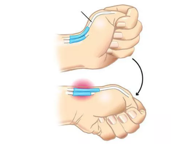 媽媽手腱鞘炎能自愈嗎 媽媽手腱鞘炎如何緩解2018