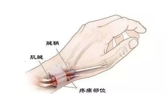 媽媽手腱鞘炎能自愈嗎 媽媽手腱鞘炎如何緩解2018