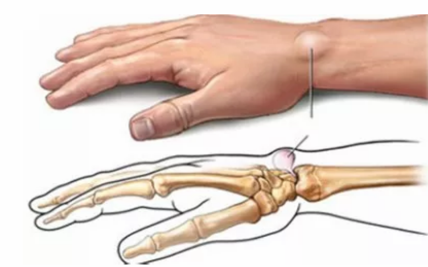 哪些習慣容易患媽媽手 媽媽手腱鞘炎怎么治療 