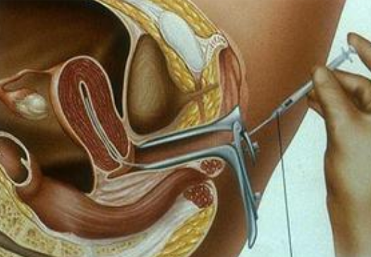 試管嬰兒取卵后什么時候來月經 試管嬰兒取卵后第二次月經什么時候來 試管嬰兒取卵后什么時候來月經 試管嬰兒取卵后第二次月經什么時候來