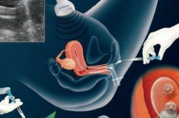 做試管嬰兒會不會出現宮外孕 宮外孕和試管嬰兒有關系嗎2018