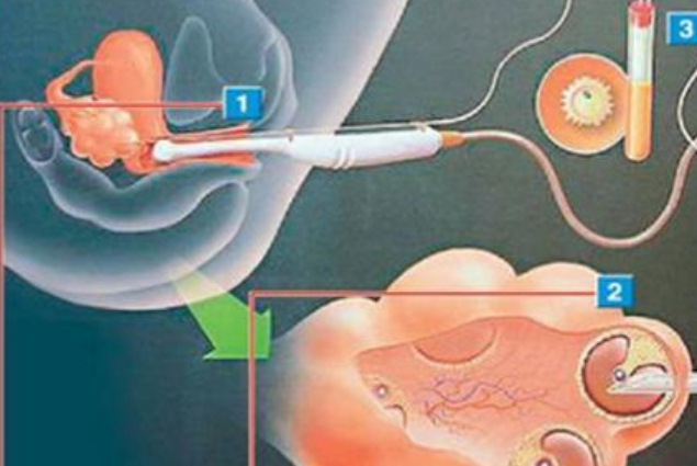 試管嬰兒取卵后月經(jīng)推遲原因2018 為什么取卵會影響生理期時(shí)間