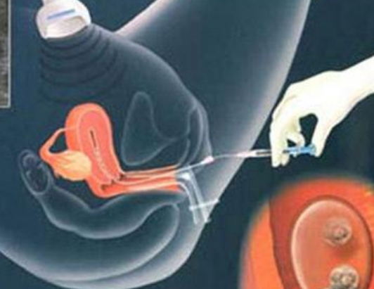 做試管嬰兒會誘發(fā)腫瘤嗎2018 子宮肌瘤可以做試管嬰兒嗎