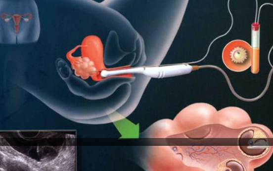 試管嬰兒促排要打多少天針2018 促排打針后什么時候能取卵