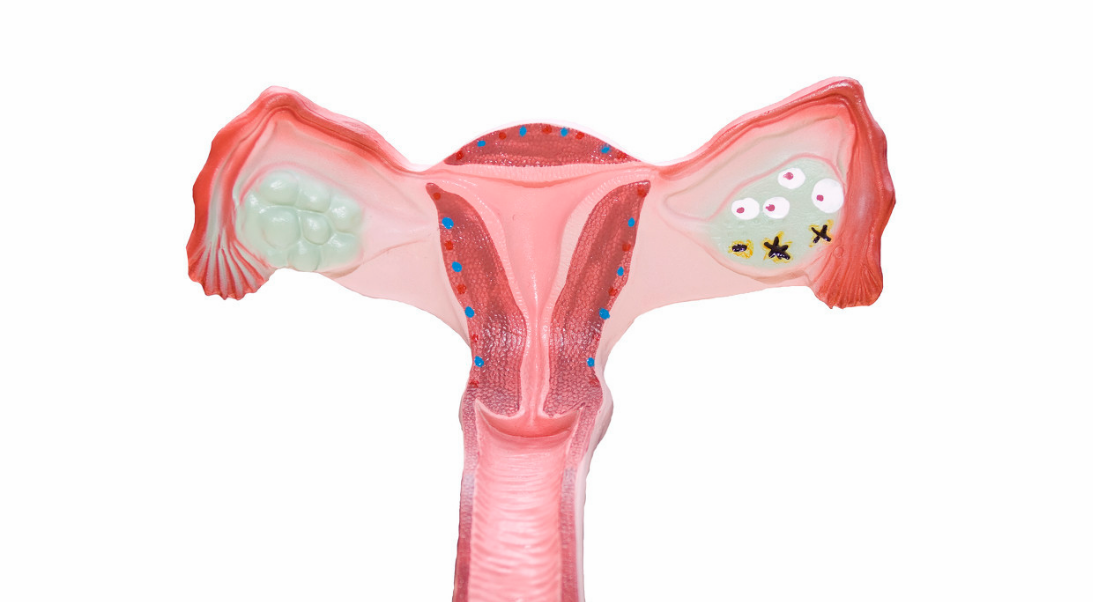 子宮后傾會造成哪些不適 如何改善子宮后傾 子宮后傾會造成哪些不適 如何改善子宮后傾