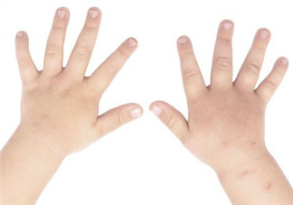 手足口病不吃藥能自愈嗎 手足口病多久可以自愈