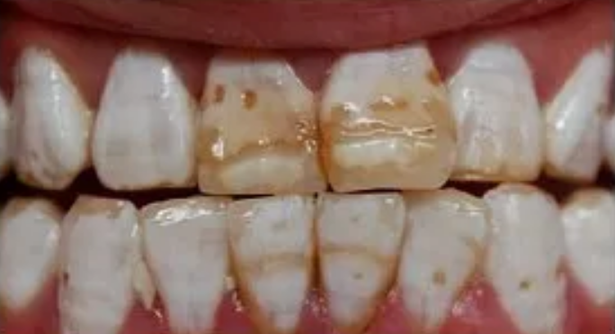 孩子用含氟牙膏會導致氟斑牙嗎 3歲以下的孩子有必要用含氟牙膏嗎