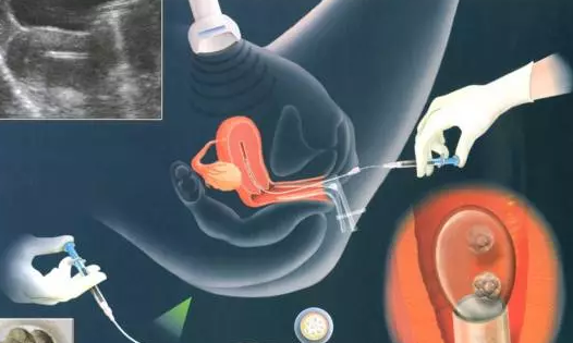 做一次試管嬰兒要幾天 試管嬰兒周期大概多長時間