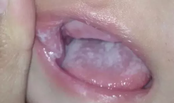 孩子口里有白點是鵝口瘡嗎 孩子鵝口瘡有哪些癥狀2018