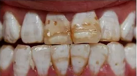 孩子刷牙齒不能用含氟牙膏嗎 孩子用含氟牙膏會變成氟斑牙嗎