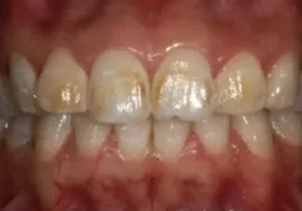 孩子用含氟牙膏會導致氟斑牙嗎 3歲以下的孩子有必要用含氟牙膏嗎