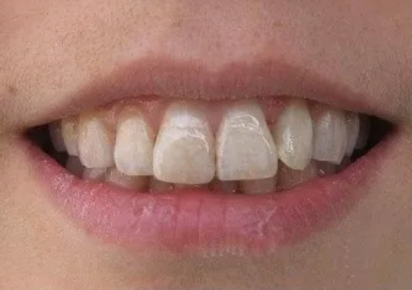 孩子用含氟牙膏會導致氟斑牙嗎 3歲以下的孩子有必要用含氟牙膏嗎