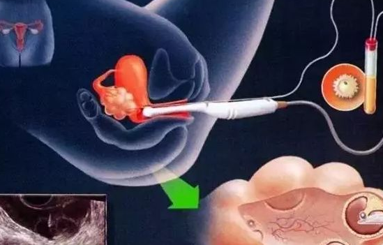 試管嬰兒促排卵失敗是什么原因 哪些食物有促排卵功效 試管嬰兒促排卵失敗是什么原因 哪些食物有促排卵功效