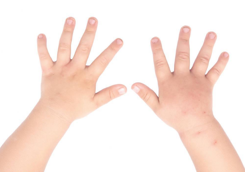 孩子被蚊子咬了怎么止癢比較好 孩子蚊蟲叮咬后止癢方法2018