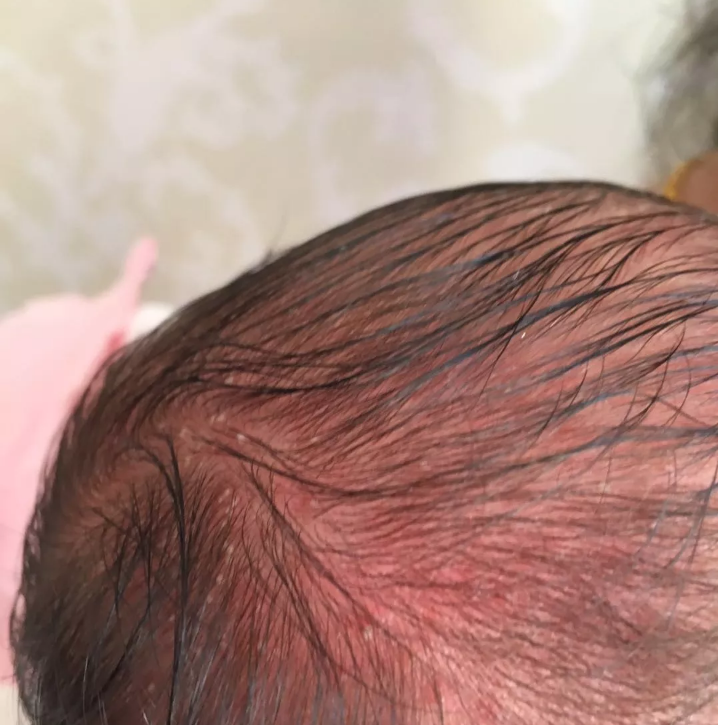 孩子毒性紅斑怎么護理 怎么護理得毒性紅斑的孩子2018 孩子毒性紅斑怎么護理 怎么護理得毒性紅斑的孩子2018