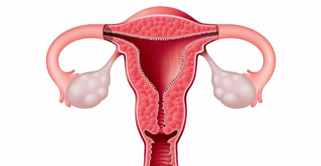 如何區別卵巢腫瘤與水瘤 巧克力囊腫是水瘤嗎