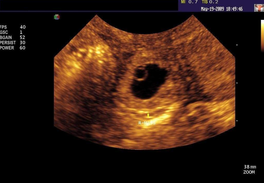 哪些檢查能診斷子宮外孕 什么情況容易發(fā)生宮外孕