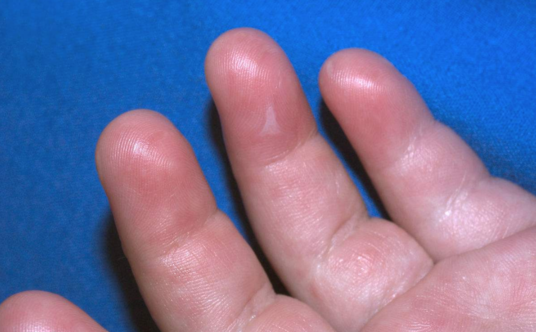 幼兒手足口病怎么鑒別輕重癥 寶寶手足口病會自愈嗎