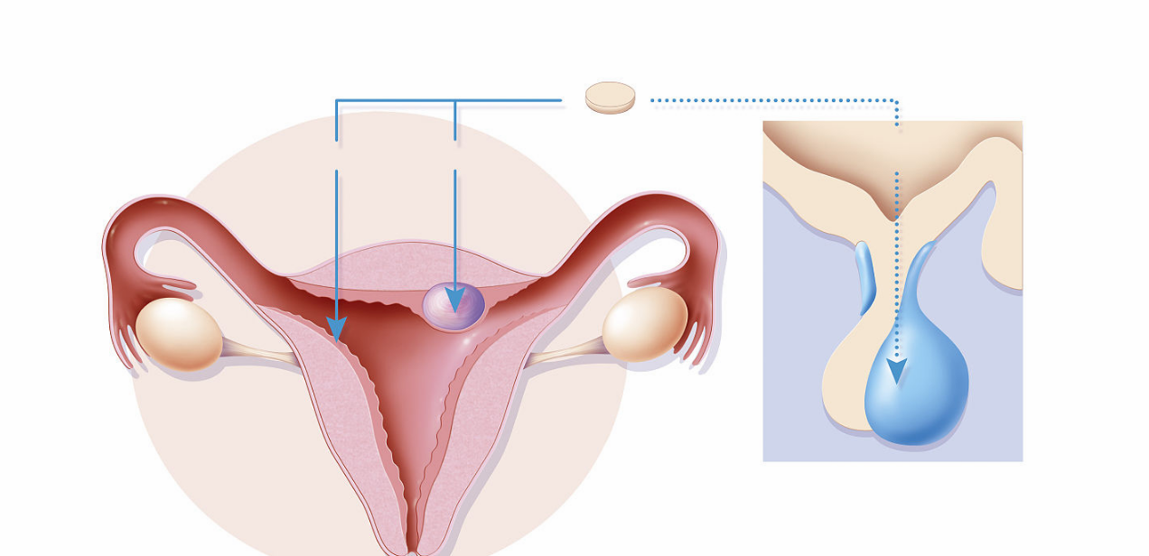 輕刮子宮能提高試管嬰兒胚胎著床率嗎 為什么輕刮子宮能提高胚胎著床率 輕刮子宮能提高試管嬰兒胚胎著床率嗎 為什么輕刮子宮能提高胚胎著床率