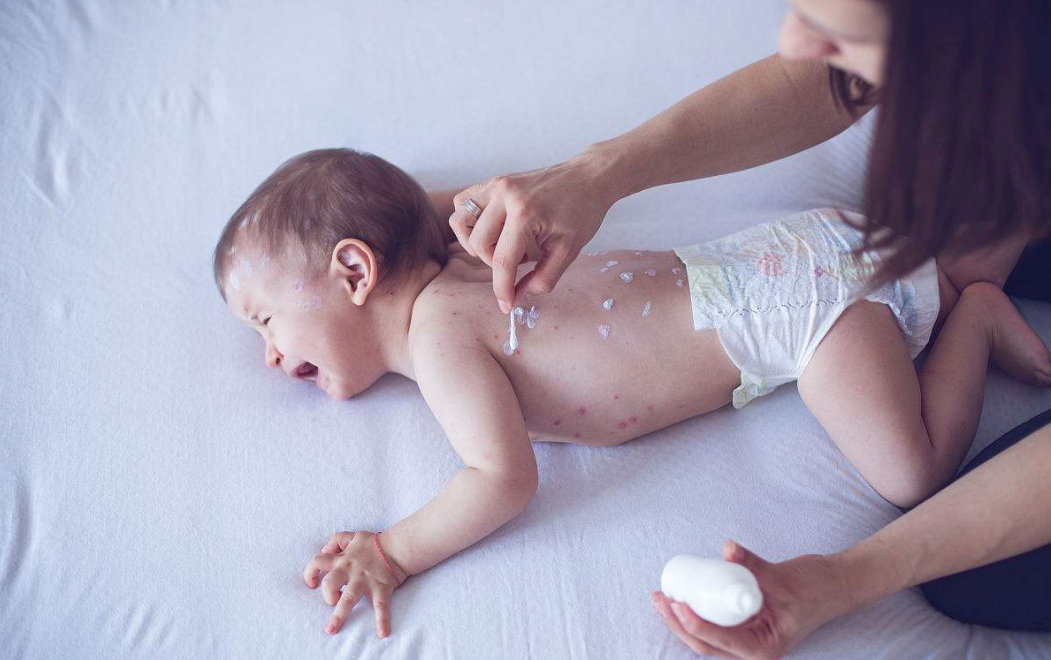 伴隨著發燒的發疹疾病有哪些 寶寶發疹應如何處理 伴隨著發燒的發疹疾病有哪些 寶寶發疹應如何處理