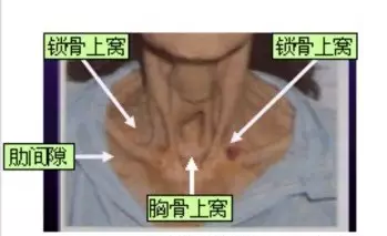 孩子吃西瓜噎住了怎么辦 西瓜肉卡喉嚨緊急處理方法2018