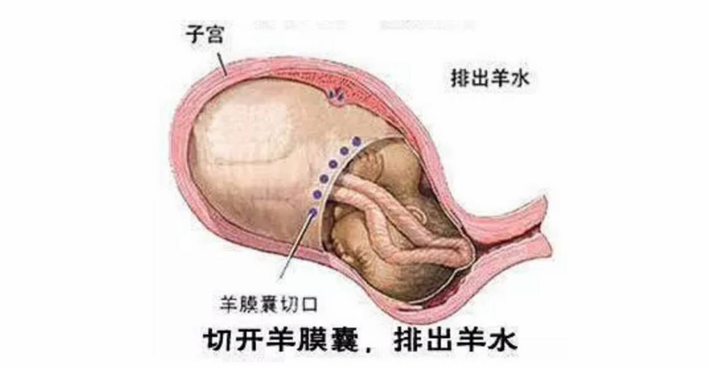 剖腹產后黏連怎么回事 如何預防剖腹產黏連