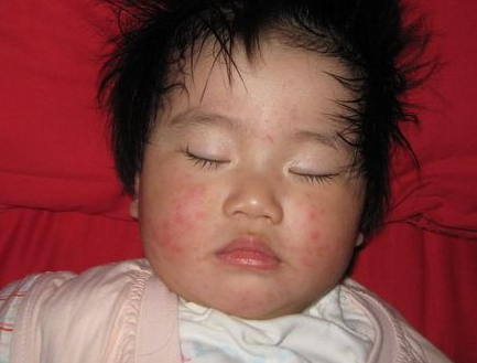 ?孩子起風(fēng)疹是什么引起的 孩子風(fēng)疹消退方法2018