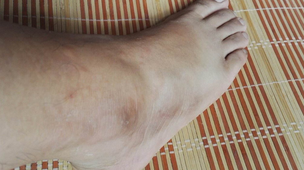 ?孩子起風(fēng)疹是什么引起的 孩子風(fēng)疹消退方法2018