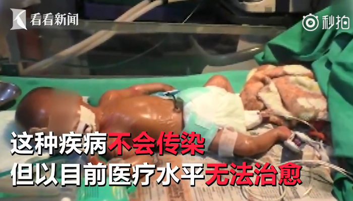 印度出現(xiàn)塑料嬰兒和環(huán)境有關(guān)嗎 印度塑料嬰兒能活多久 