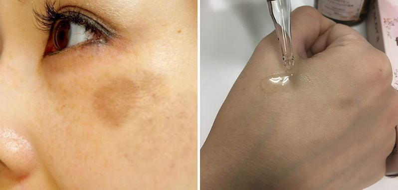 fracora胎盤素精華原液能祛斑嗎 fracora胎盤素精華原液效果好不好 fracora胎盤素精華原液能祛斑嗎 fracora胎盤素精華原液效果好不好