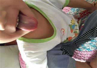 手足口病一般幾天能好 2018孩子得手足口病怎么辦好