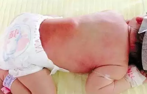 寶寶涼席性皮炎怎么辦 寶寶睡涼席有皮炎怎么回事