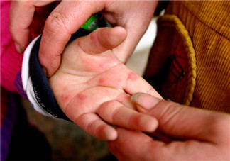 寶寶手足口水泡可以挑破嗎 最好不要挑破容易感染