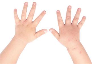 孩子被蚊子咬了之后有水泡是什么原因 怎么避免孩子被蚊子咬2018