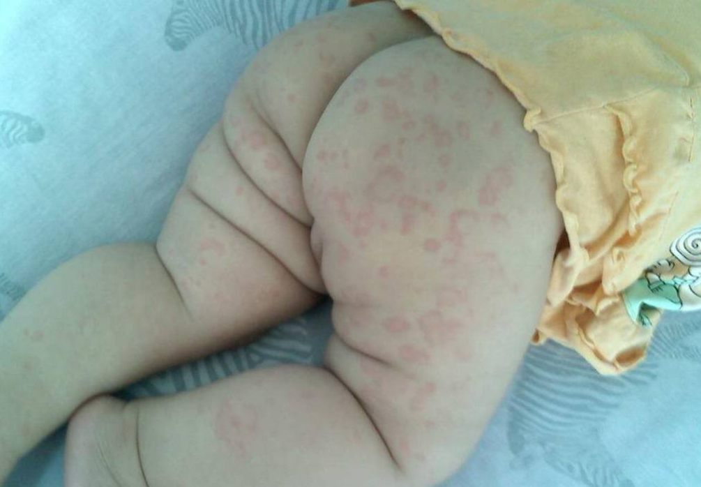 怎么判斷孩子是否對(duì)牛奶過(guò)敏 牛奶過(guò)敏的嬰兒怎么吃好 怎么判斷孩子是否對(duì)牛奶過(guò)敏 牛奶過(guò)敏的嬰兒怎么吃好