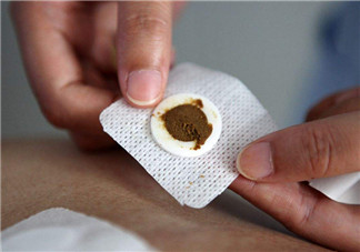 貼三伏貼能不能治療過敏 2018冬病夏治三伏貼有用嗎