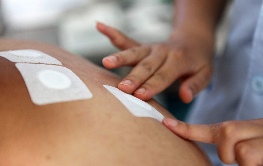 貼三伏貼能不能治療過敏 2018冬病夏治三伏貼有用嗎